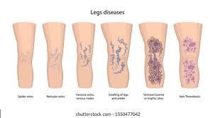 Image result for Pigment stains on the shin