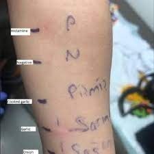 Pdf Garlic Allergy A Rare Cause Of Anaphylaxis In Infants