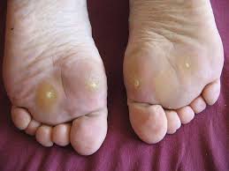 Calo Seco No Dedo Do Pé La Cinta Adhesiva Puede Eliminar Los Ojos De Pescado Remedios Para Verrugas Remedios Para Pies Planta De Los Pies