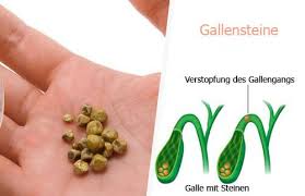 Gallensteine (cholelithiasis) sind schmerzhafte ablagerungen in gallenblase oder im gallengang. 7 Naturliche Getranke Gegen Gallensteine Besser Gesund Leben