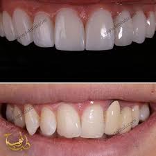 صور هوليود سمايل قبل وبعد عملية تجميل الانف ابتسامة هوليود زراعة الشعر في ايران