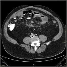 Despite many histopathologic similarities between peritoneal and . Primary Peritoneal Mesothelioma