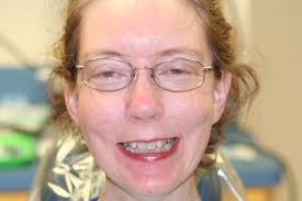 Before and After Invisalign Class II div 2