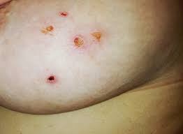 Morgellons disease information, support and research foundation helps people understand morgellons disease, it's symptoms and how to cope. What Is Morgellons Disease The Charles E Holman Foundation