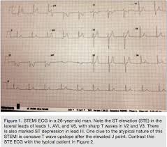 Is This A True Stemi Ecg Typical And Atypical Findings Cath Lab Digest