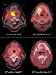 Basal cell carcinoma patches most often develop in areas exposed to the sun, such as the head, neck, hands, and arms, but they can develop on other parts of the body. The Prognostic Role Of 18f Fluorodeoxyglucose Pet In Head And Neck Cancer Depends On Hpv Status Radiotherapy And Oncology