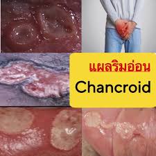 Image result for chancroid