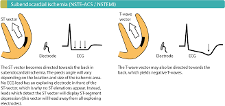 Within this group the rate of referral to cabg was significantly higher. Ecg In Myocardial Ischemia Ischemic Changes In The St Segment T Wave Ecg Echo