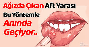 Agzimda Aft Cikti Nasil Gecer Agiz Icerisinde Ufak Yada Buyuk Bicimde Gorunen Bir Baska Ismi De Agiz Ici Yarasi Olan Aft S Health Diet And Nutrition Eye Care