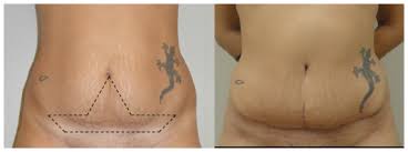 Of course, the size and location of the tattoo will determine if this is possible, but for those tattoos that dr. Tattoo Preservation During Surgical Procedures Oas
