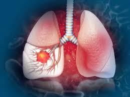 Lung cancer may not produce any noticeable symptoms in the early stages, and many people aren't diagnosed until the disease has advanced. Lung Cancer What Is Stage 3 Lung Cancer Symptoms Treatment And All You Need To Know Health Tips And News