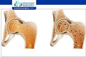 You can also connect up with a support group. Stage 4 Bone Cancer Bone Cancer Stage 4 Treatment Iranian Surgery