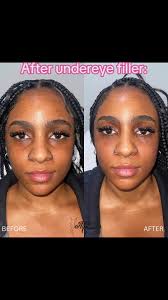 Achieve Instant Results with Minimal Bruising!