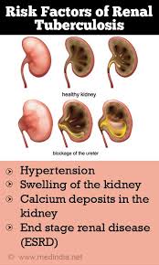 Suggest home remedies for diabetes control. Renal Tuberculosis Causes Symptoms Complications Diagnosis Treatment