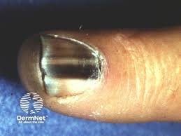 Image result for Acral lentiginous melanoma nail