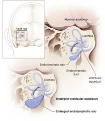 Enlarged Vestibular Aqueducts Eva Hearing Loss Nidcd
