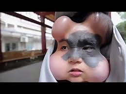 ការព្យាបាលដ៏ចម្លែកមួយ នៅលេិស្នាមដៅលេីមុខពីកំណេីត