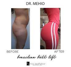 Mehio in mia aesthetics with @mia_aesthetics_miami. Mia Aesthetics On Twitter This Dr Mehio Transformation Is Https T Co 3uficdgcsx Twitter