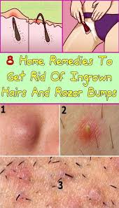 What are ingrown hairs and how do you get rid of them?getty images. Pin On Private Part Washing