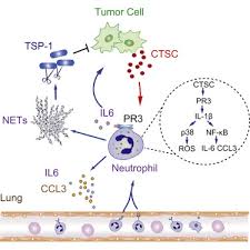 The spread of breast cancer is called metastatic breast cancer. Cathepsin C Promotes Breast Cancer Lung Metastasis By Modulating Neutrophil Infiltration And Neutrophil Extracellular Trap Formation Sciencedirect