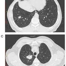 Smokers have the greatest risk of developing lung cancer, and quitting smoking greatly. Pdf Asymptomatic Pulmonary Tuberculosis Mimicking Lung Cancer On Imaging A Retrospective Study
