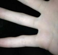Find out how rheumatoid arthritis affects your joints and what you can do to treat it. Health Expert Explains What Smartphone Pinky Is And How You Can Combat It Mirror Online
