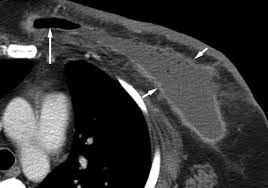 Medicare coverage includes a prescreening counseling visit with the however, the lifetime risk of cancer from a single ct scan was small—about one case of cancer for every 10,000 scans performed on children. Breast Lesions Incidentally Detected With Ct What The General Radiologist Needs To Know Radiographics