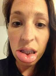 People share their worst bee sting lips