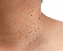 Skin Tags What Are They And What Can You Do About Them