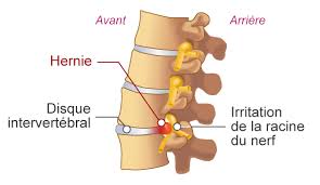 Tour de reins, lumbago, sciatique. Qu Est Ce Qu Une Lombalgie Lomboradiculalgie La Rhumatologie Pour Tous