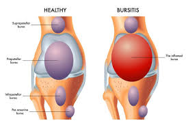 Bursa'da i̇yi parti'den hal esnafına ziyaret. Is My Joint Pain Arthritis Or Bursitis Towson Orthopaedic Associates
