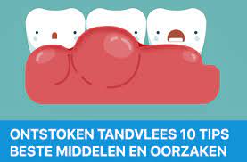 Check spelling or type a new query. Ontstoken Tandvlees Ontstoken Tandvlees Top10 Tips Beste Middelen