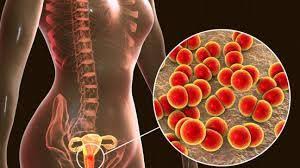 Les personnes traitées pour la gonorrhée reçoivent également un traitement contre la chlamydia car elles ont souvent ces deux infections en même temps. Les Aliments Pour Traiter La Gonorrhee