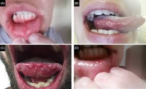 Crohn S Disease Inflammatory Type Sciencedirect