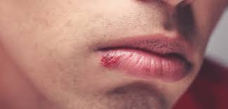 Pata tratar este tipo de enfermedades se recetan fármacos antivirales que puede acelerar la curación y reducir el peligro de padecer dificultades. Virus Del Herpes Simple Herpes Oral Y Genital Poz