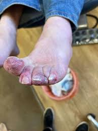 Image result for Chilblains