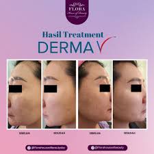 Hi Beauties!✨ Ini dia foto Before & After salah satu pasien kami setelah  Treatment Derma V by Flora House of Beauty! Kulit wajah terlihat lebih  fresh dan cerah 'kan? 🥰 Sekarang giliranmu!