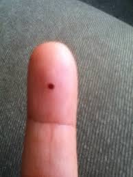 Causes may include mouth cancer, oral herpes and at time diabetes. Tiny Blood Blister Inside Cheek