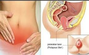 Nyeri perut sebelah kanan merupakan sensasi sakit, nyeri, perih, yang dirasakan pada daerah sisi sebelah kanan pusat, di bawah tulang rusuk dan di atas selangkangan. Awas Jangan Sampai Terkeluar Jom D Jamu Chenta Hq Facebook