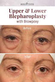 Procedure Upper And Lower Blepharoplasty Browpexy Patient Wanted To Get Rid Of The Bags Under Her Eyes And Appear Eyelid Surgery Eye Bag Surgery Eye Surgery