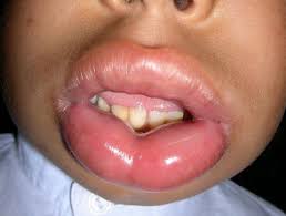 Type i hypersensitivity reaction that is either severe in nature or having two or more organ systems involved. Angioedema Dermnet Nz