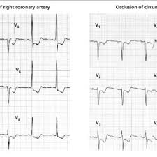Dari wikibuku bahasa indonesia, sumber buku teks bebas. St Segment Changes In The Precordial Leads During Occlusions Of The Download Scientific Diagram