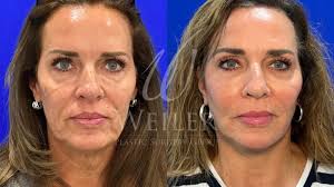 Facelift Before and After Photo Gallery