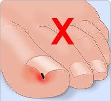 Faq Ongle Incarne