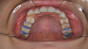 セパレーション ゴム