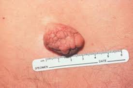 Detailed information on benign skin growths. Benign Skin Lesions Overview Defining The Lesion Papules And Plaques