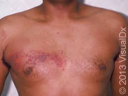 Image result for zoster under breasts