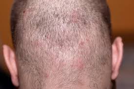 Image result for Tinea Capitis