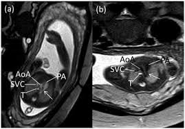Pregnancy week by week with pictures of the babys progress and lots of information. A A 25 Week Old And B 24 Week Old Fetus Showing The Normal Download Scientific Diagram