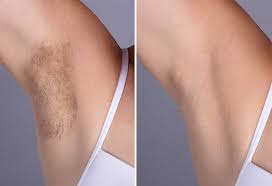 I worried about the same thing when i was younger too. 9 Effective Ways To Remove Underarm Armpit Hair